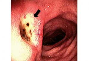 GI ulcer
