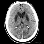 3-brain-of-a-cardiac-arrest-victim-medical-body-scans