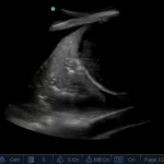 lung ultrasound