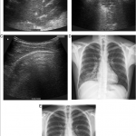 Pneumonia lung US
